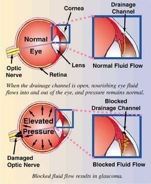 Glaucoma Infographic - Family EyeCare Center