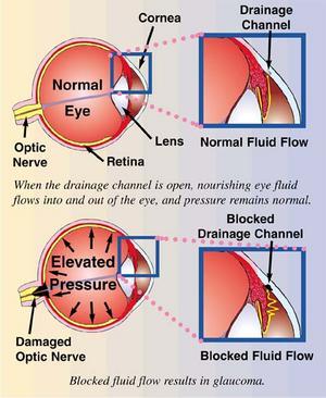 GLAUCOMA3.8ed3eecda2135a0290b4ea87de7e41d7 Glaucoma Infographic - Family EyeCare Center
