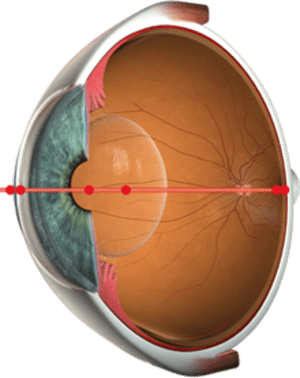 Cataract Management - Family EyeCare Center