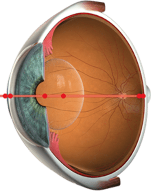 ascan.72e2be3bd98a7fba92b53662d670bb65 Cataract Management - Family EyeCare Center