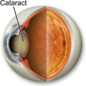 Cataract Management - Family EyeCare Center