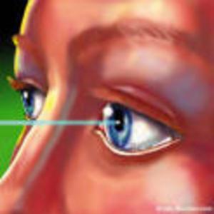 Laser Eye Procedure Graphic - Family EyeCare Center
