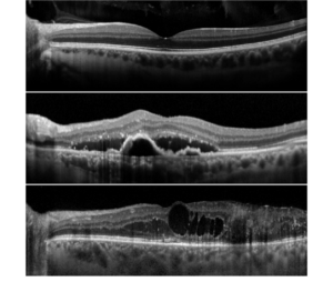 OCT image OCT Imaging - Family EyeCare - Quincy, IL