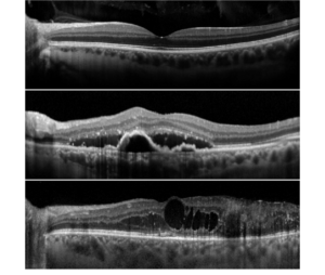 OCT Imaging - Family EyeCare - Quincy, IL