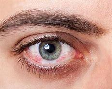 Dry Eye Treatment - Family EyeCare - Quincy, IL