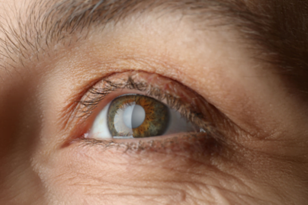 How can cataracts affect your eyes? 3