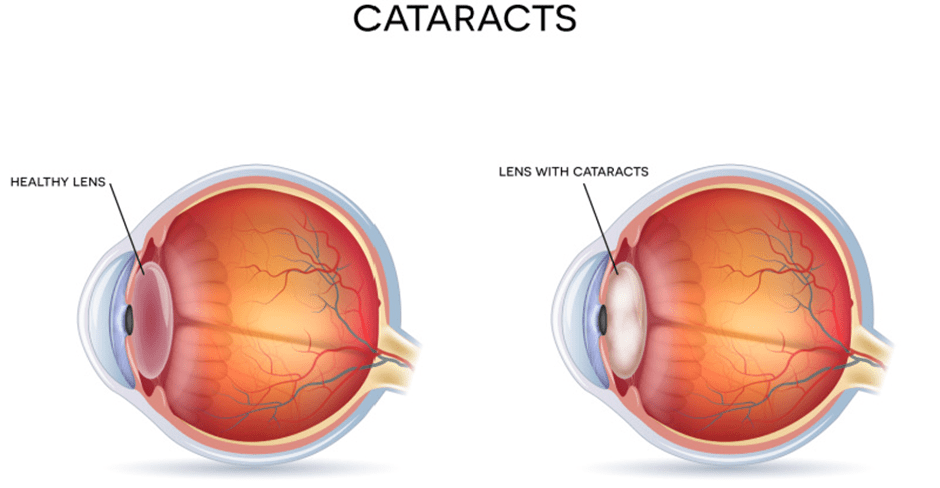 How can cataracts affect your eyes? 1