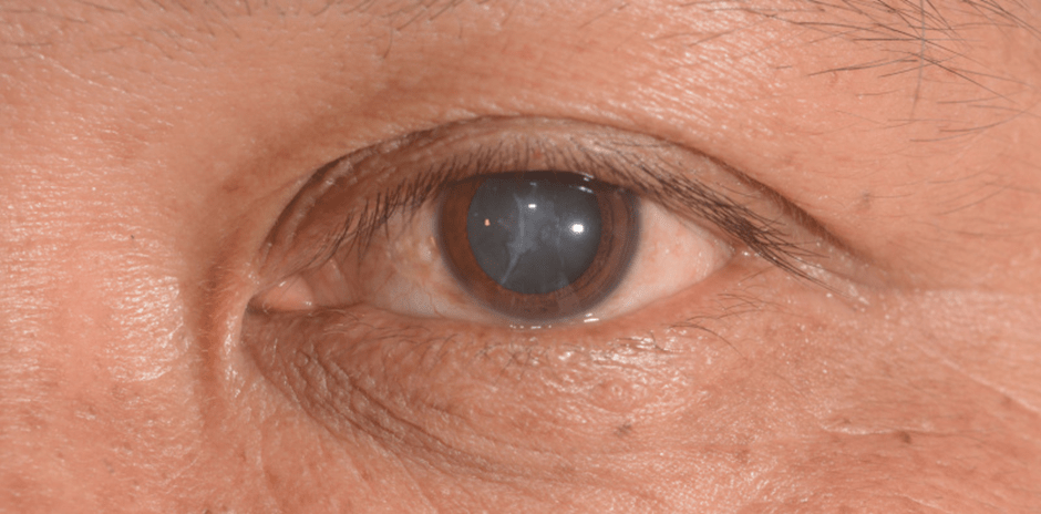 How can cataracts affect your eyes? 3