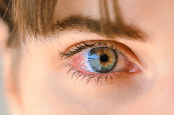 Managing dry eye disease 1