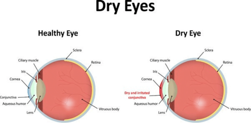 Managing dry eye disease 4 Managing dry eye disease 3