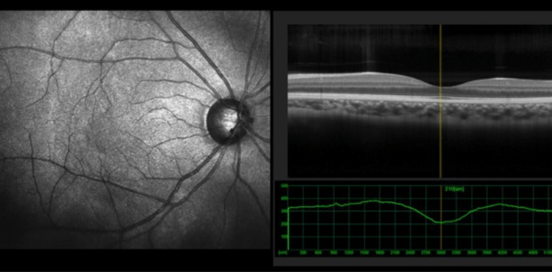 Discover the cutting-edge brilliance of OCT and Optos at Family Eyecare 3