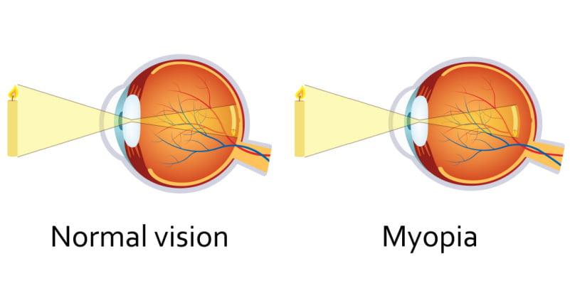 What is myopia