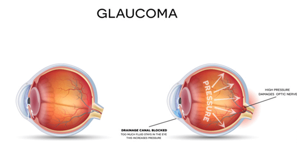 Glaucoma