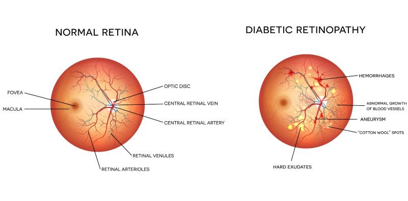 Diabetic Retinopathy Eye Diagram