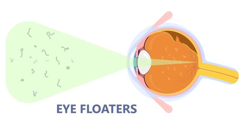 What are eye floaters 2 Eye Floaters
